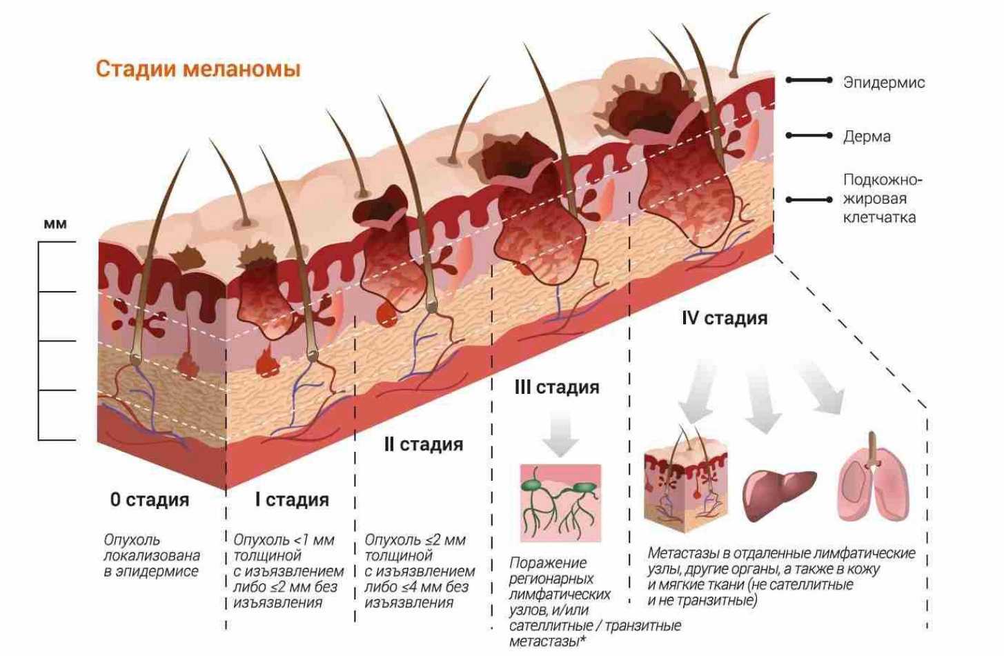 Удаление меланомы кожи. Стадииразвития меланосомы. Стадии развития меланомы. Схема патогенеза меланомы кожи.