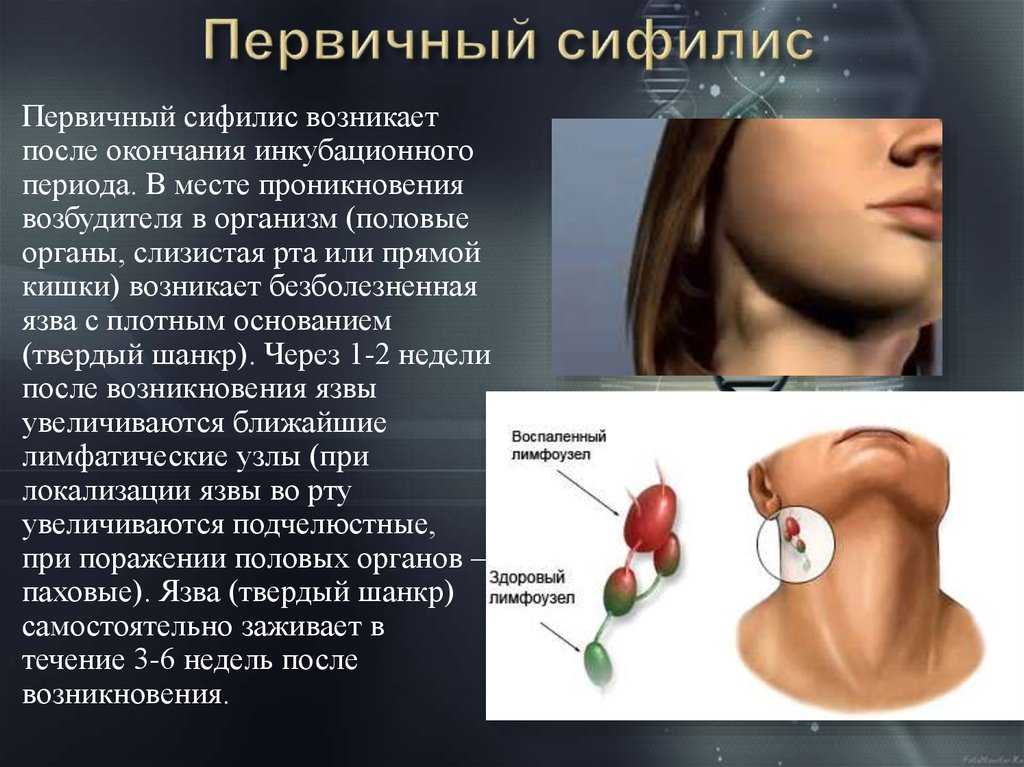 Бартолинит— воспаление бартолиновых желез: диагностика и лечение