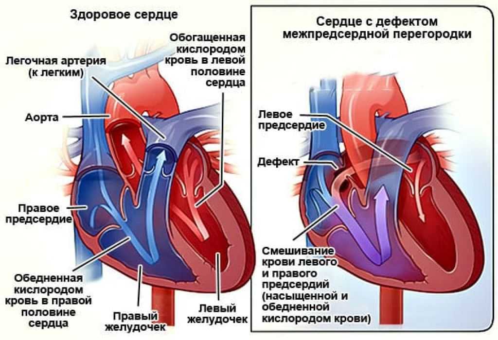 Открытое овальное окно: как проявляется, когда и чем опасно