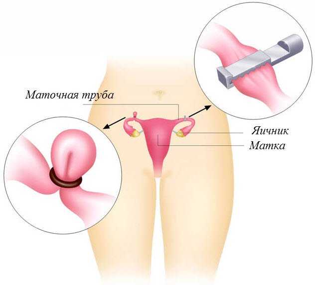 Стерилизация женщин: плюсы и минусы, виды и последствия процедуры