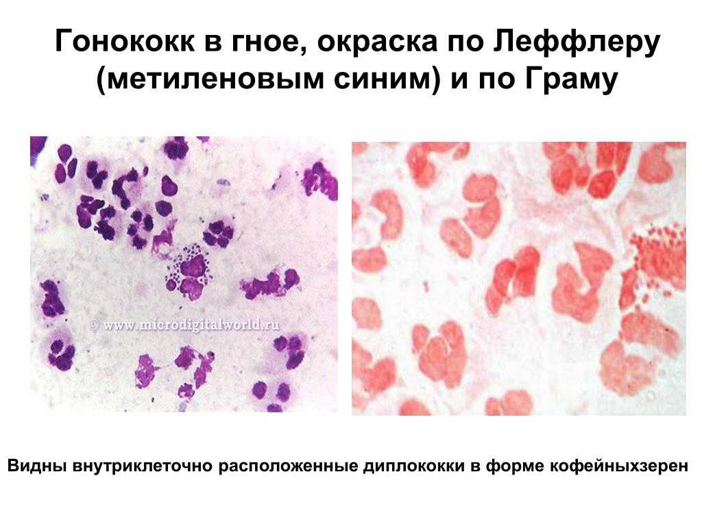 Диплококки в мазке у женщин: причины появления, что это такое?