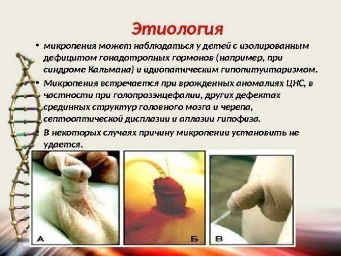 Что делать, если у ребенка фимоз?