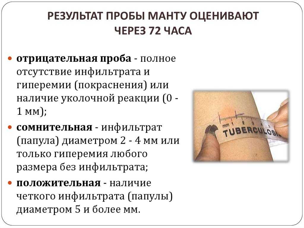 Прививка от туберкулеза - правила вакцинации детей и взрослых, противопоказания, реакции - гбуз птд №23 мз кк