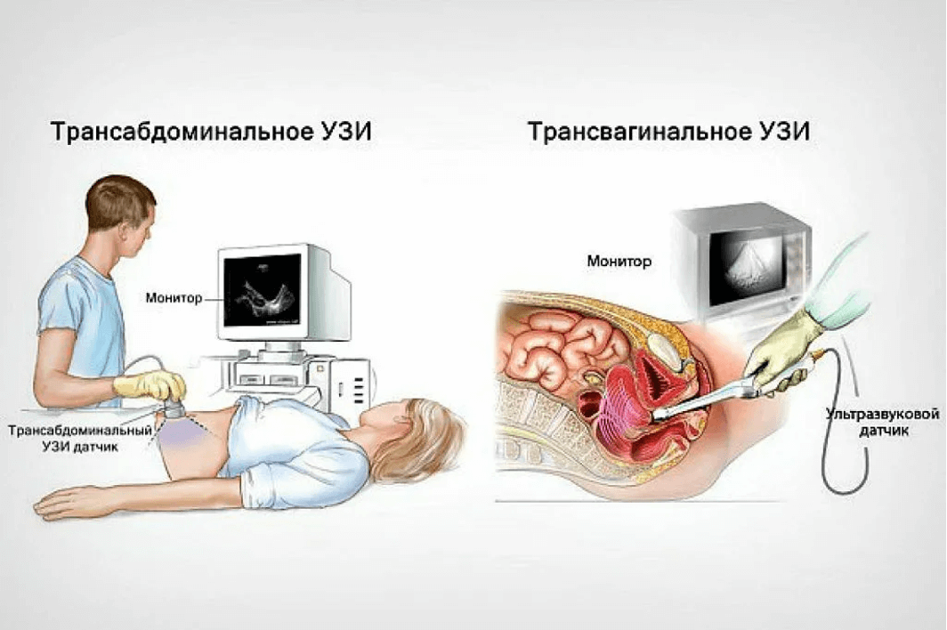 Осложненное течение кист яичника у плода и их ультразвуковая диагностика