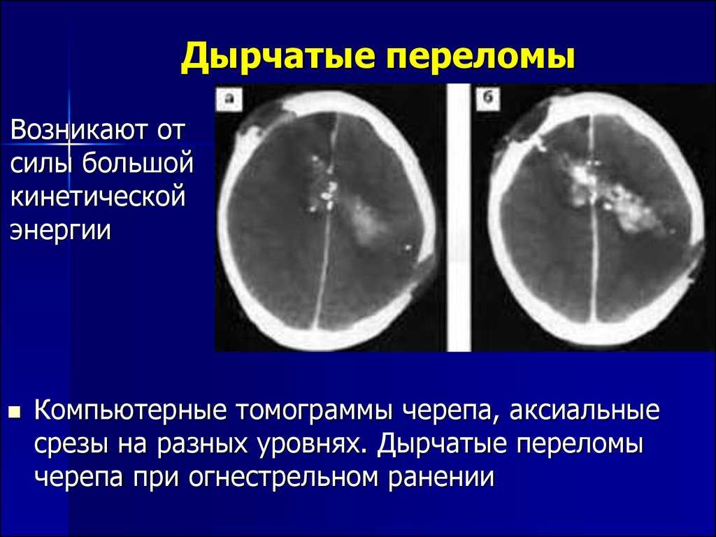 Какие могут быть последствия черепно-мозговых травм у детей?