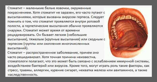Язвы в полости рта – клинические признаки при различных заболеваниях