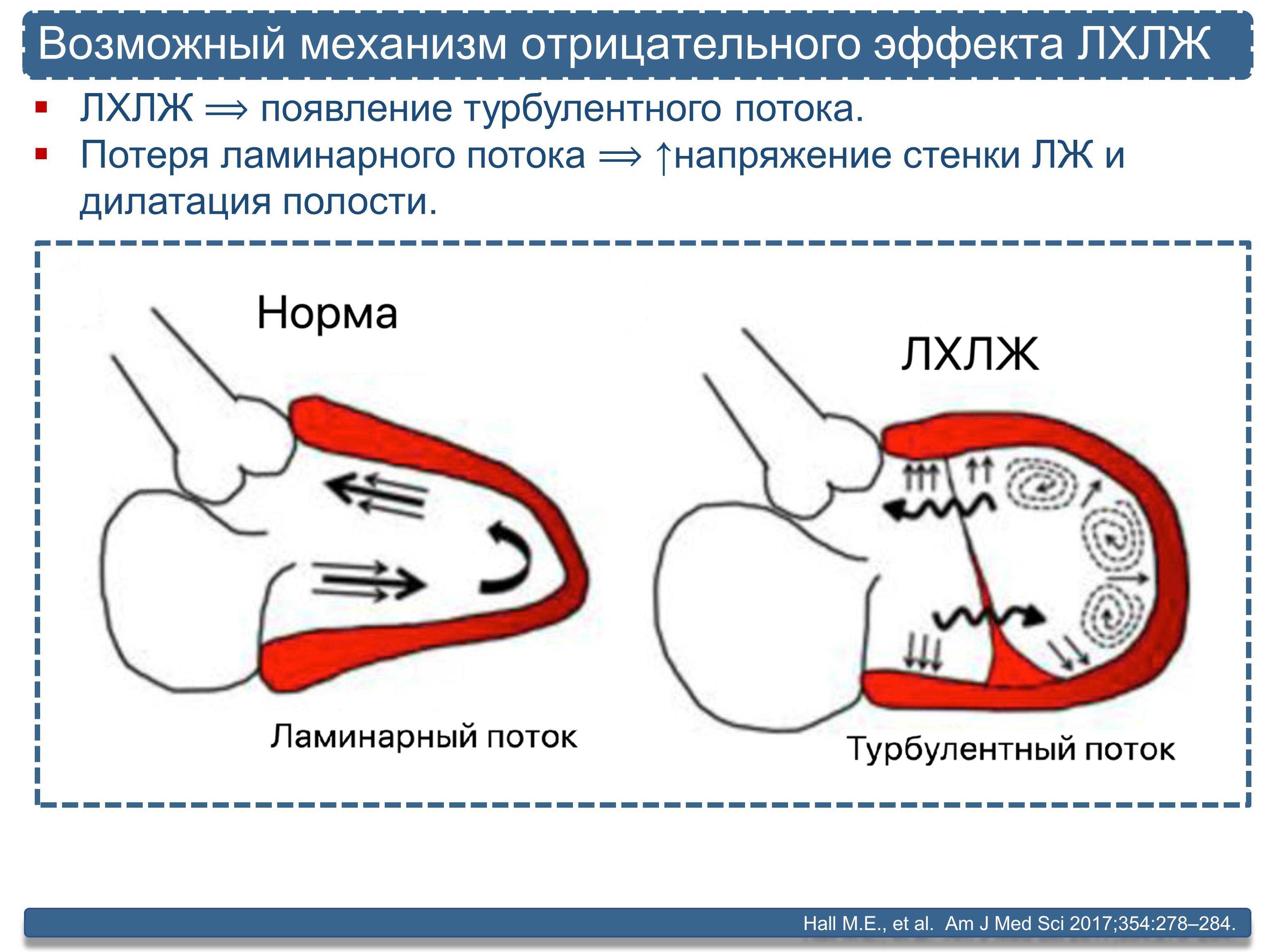 Дополнительная хорда в левом желудочке сердца – аномалия, о которой должен знать каждый