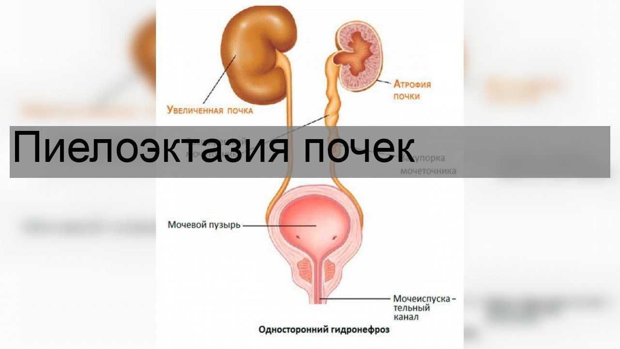 Пиелоэктазия у детей. Пиелокаликоэктазия почки что это. Пиелокаликоэктазия почки что это у взрослого. Пиелоэктазия и гидронефроз чем отличаются.