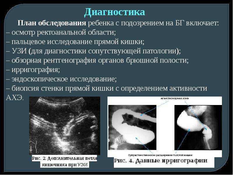 Болезнь гиршпрунга: причины, симптомы, диагностика и лечение