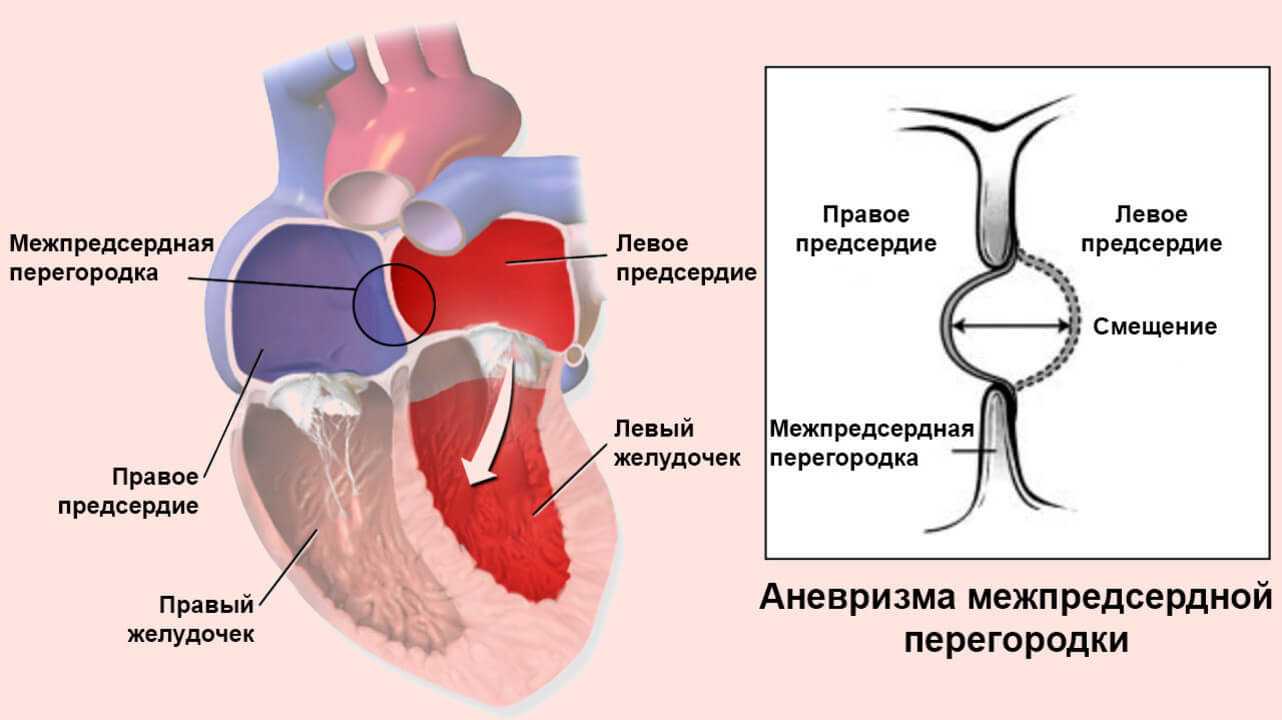 Мрт и кт сердца. кт и мрт диагностика дефекта межпредсердной перегородки