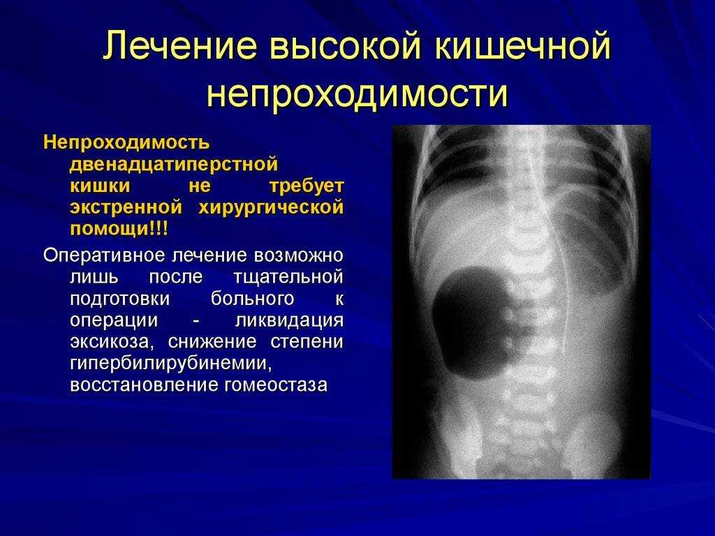 Инвагинация кишечника