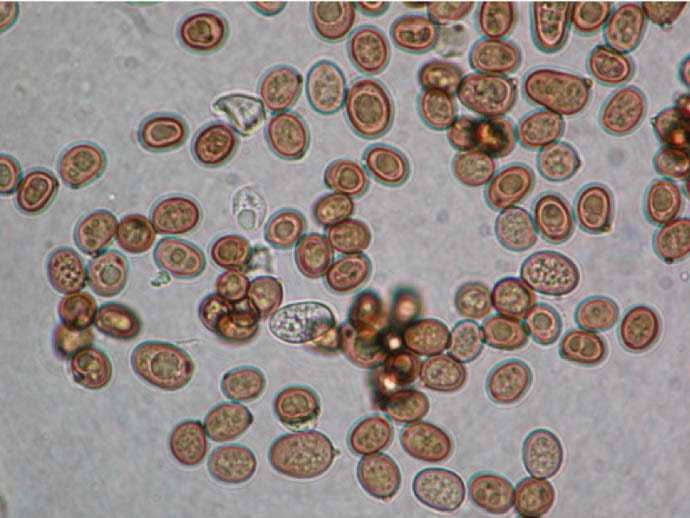 Грибы в кале копрограмма. Микроскопия кала дрожжи. Микроскопия кала дрожжевые грибки. Споры грибов в Кале микроскопия. Споры грибов под микроскопом в Кале.