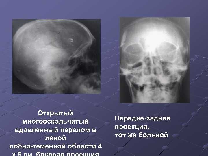 Причины, особенности и последствия линейного перелома затылочной кости у ребенка - о болезнях