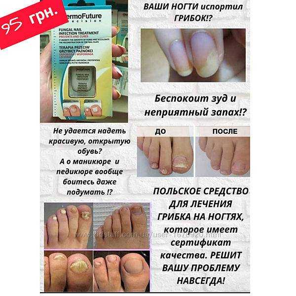 Полезен ли йод для ногтей?