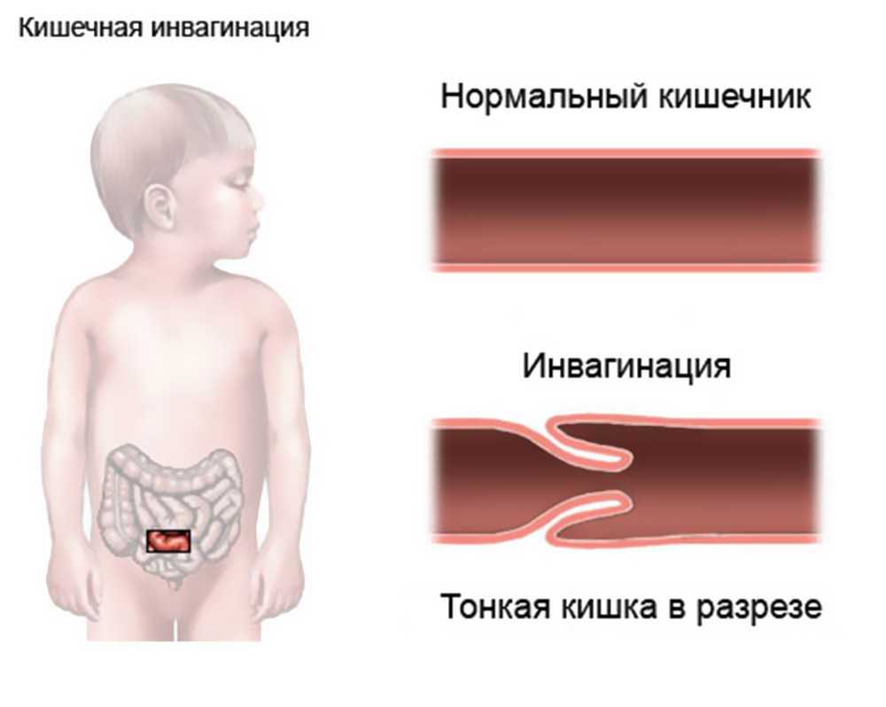 Инвагинация кишечника у детей: причины, симптомы, лечение, последствия