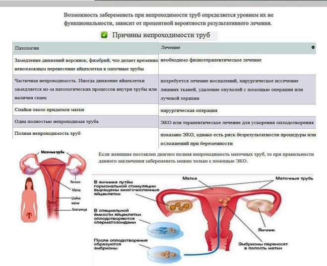 Забеременела при непроходимости труб. Эндометриоз и бесплодие. Как можно забеременеть. Непроходимость маточных труб для зачатия. Забеременела с эндометриозом.
