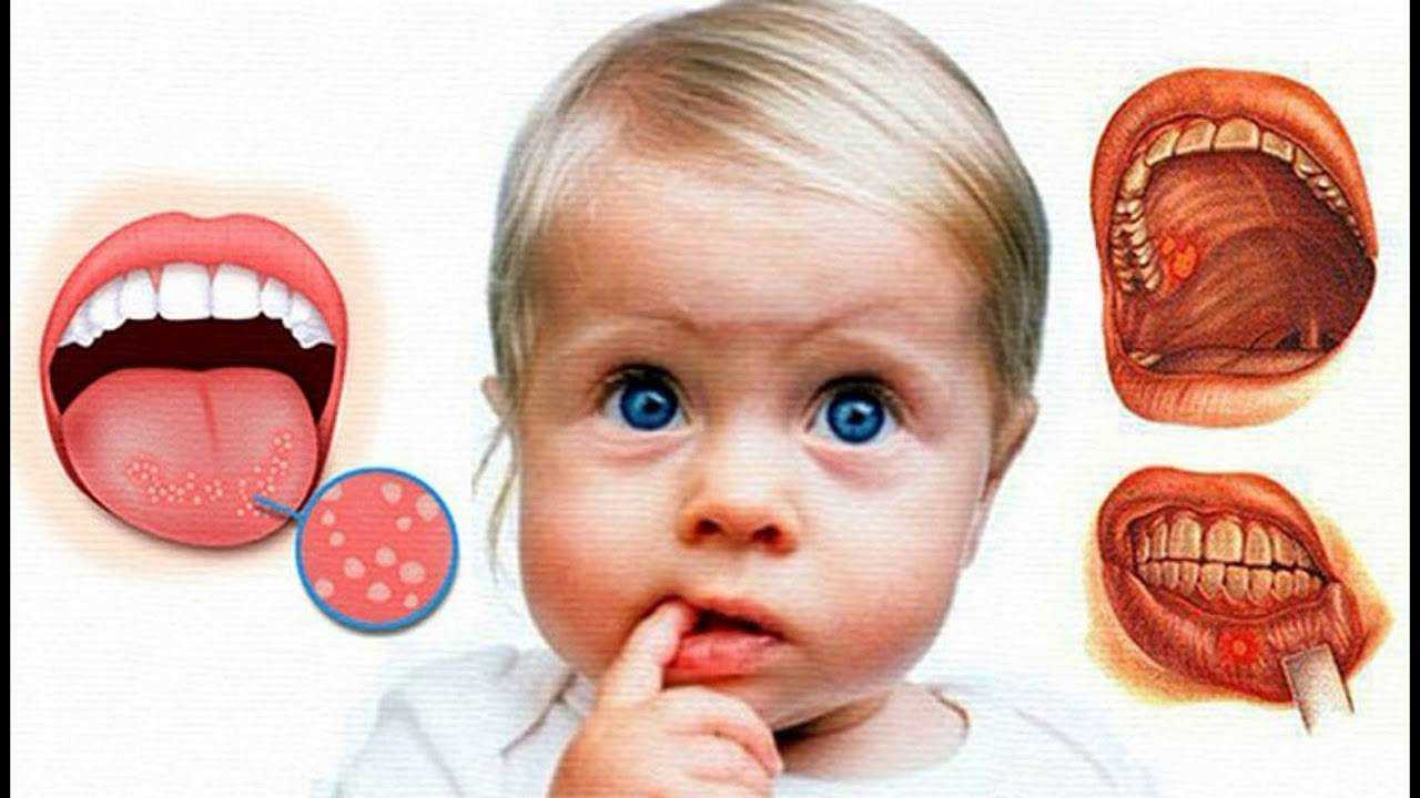 Лечение стоматита у детей - сеть стоматологических клиник санкт-петербурга - мир стоматологии