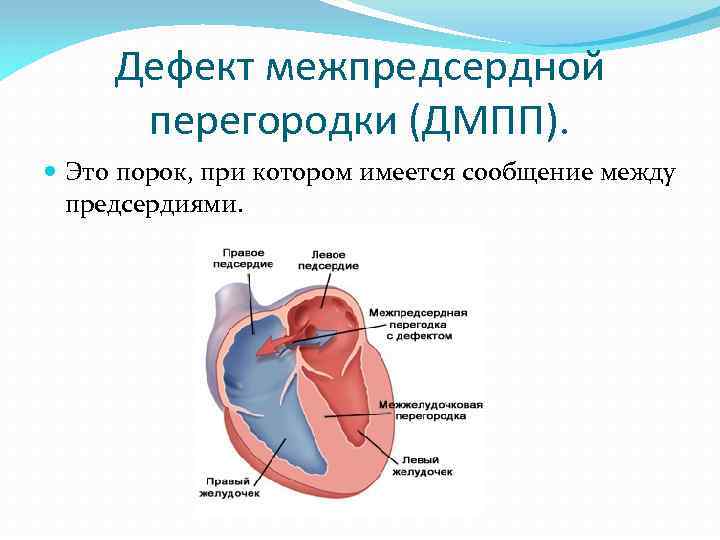Дефект межпредсердной перегородки у детей - здоров.сердцем