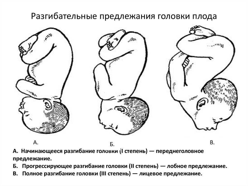 Головное предлежание плода: тонкая грань между нормой и патологией
