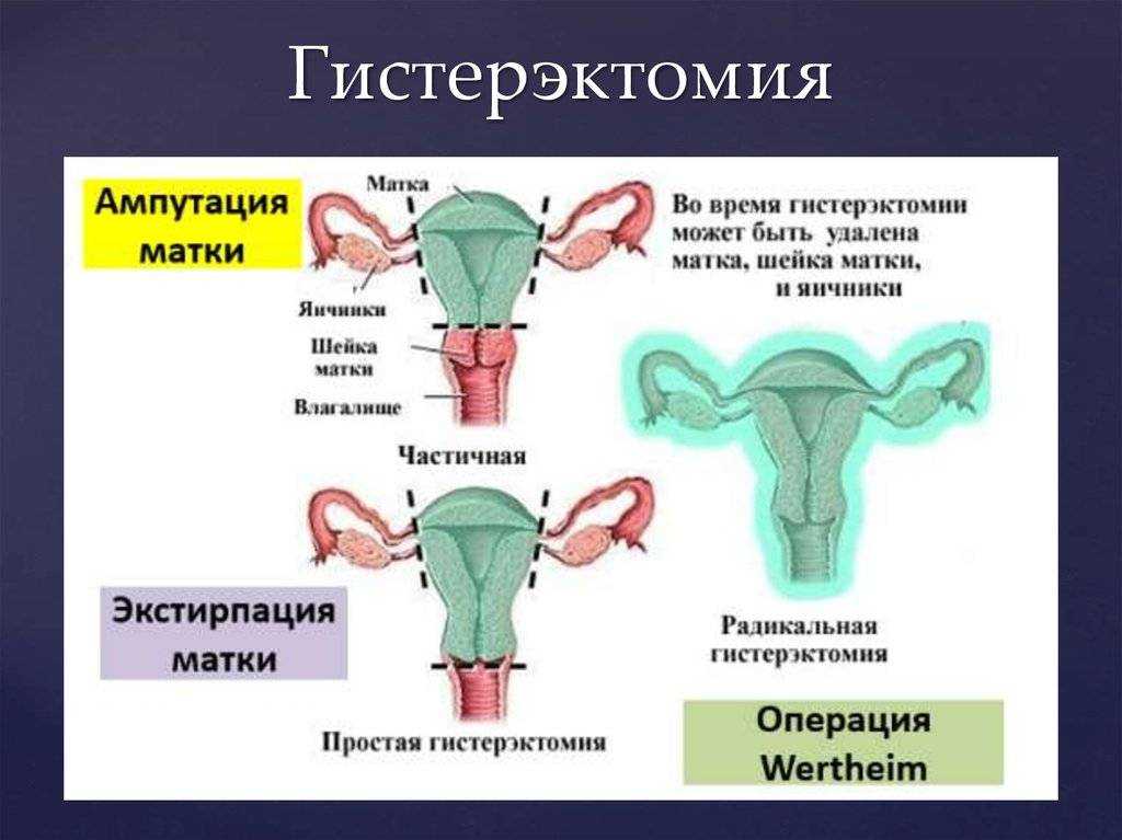 Сальпингэктомия - med24info.com