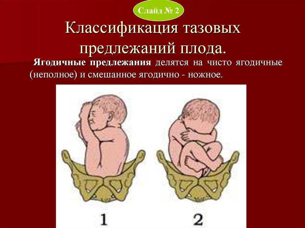 Роды при тазовых предлежаниях