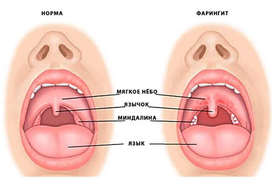 Особенности лакунарной ангины: симптомы, причины возникновения, лечение