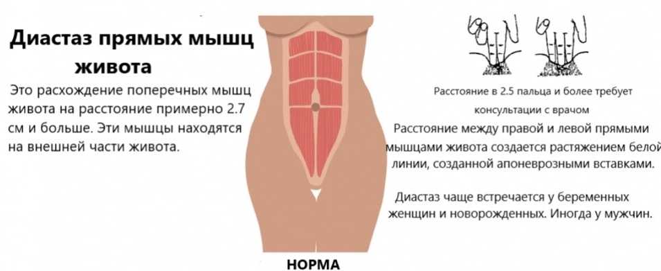 Диастаз прямых мышц живота ⋆ 2023