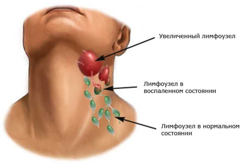 Головная боль за ушами