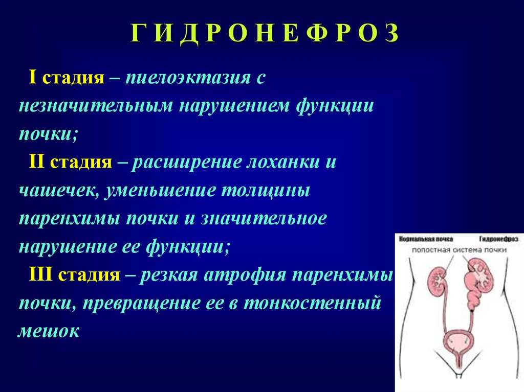 Пиелоэктазия почек у ребенка (левой, правой, обоих): что это такое, чем грозит и как лечить