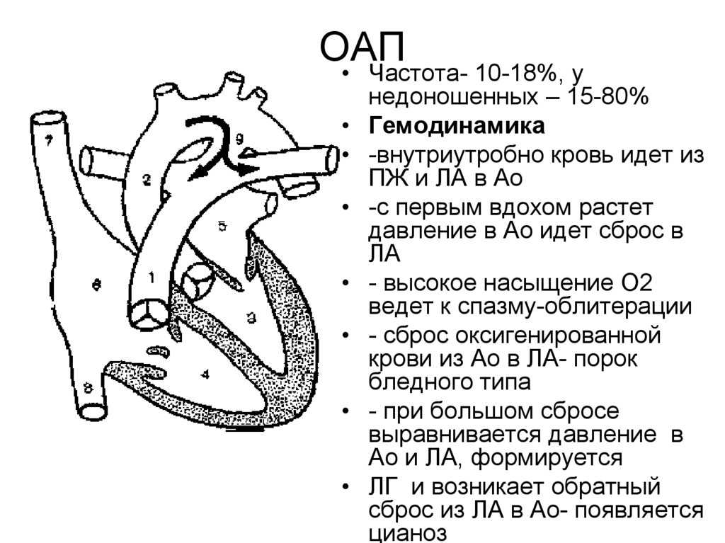 Открытый артериальный проток (оап): у детей и новорожденных, симптомы и лечение