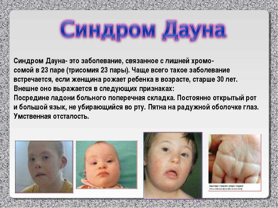 Синдром дауна: принять необычное