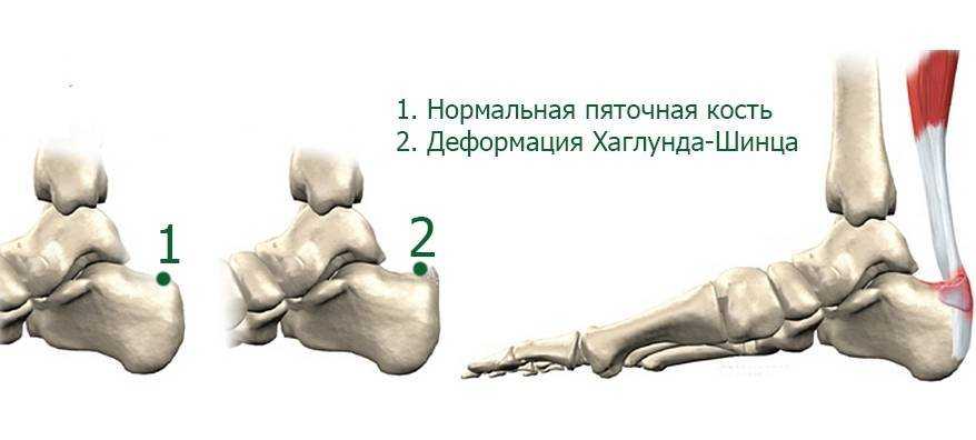 Болезнь шинца у детей 📌 - что это такое, как лечить заболевание (фото)?