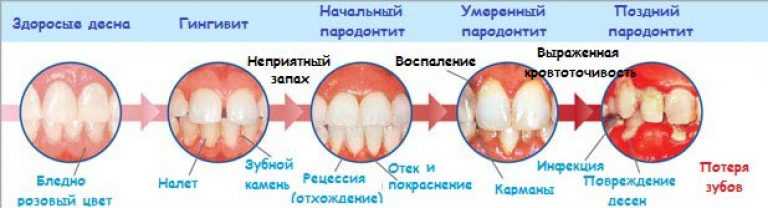 Ветряная оспа (ветрянка) у детей и взрослых: симптомы, осложнения, как не заразиться