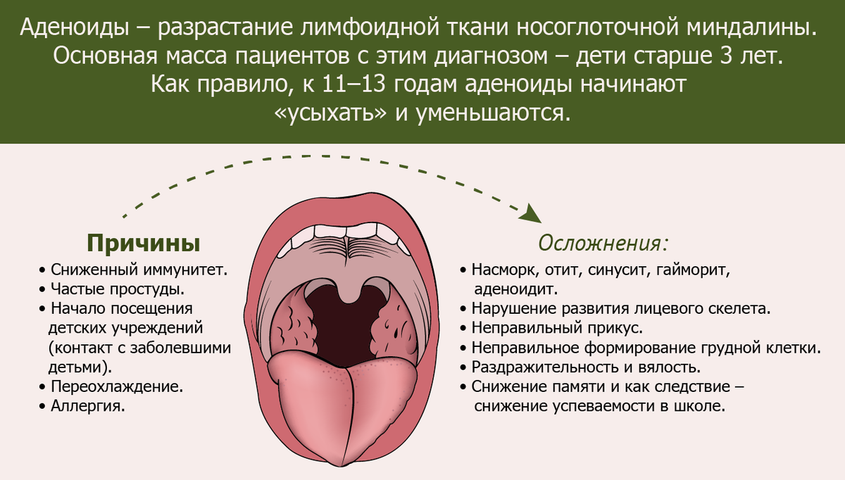 Ангина у детей