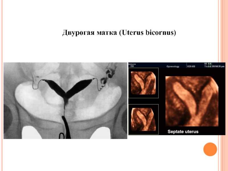 Миома матки