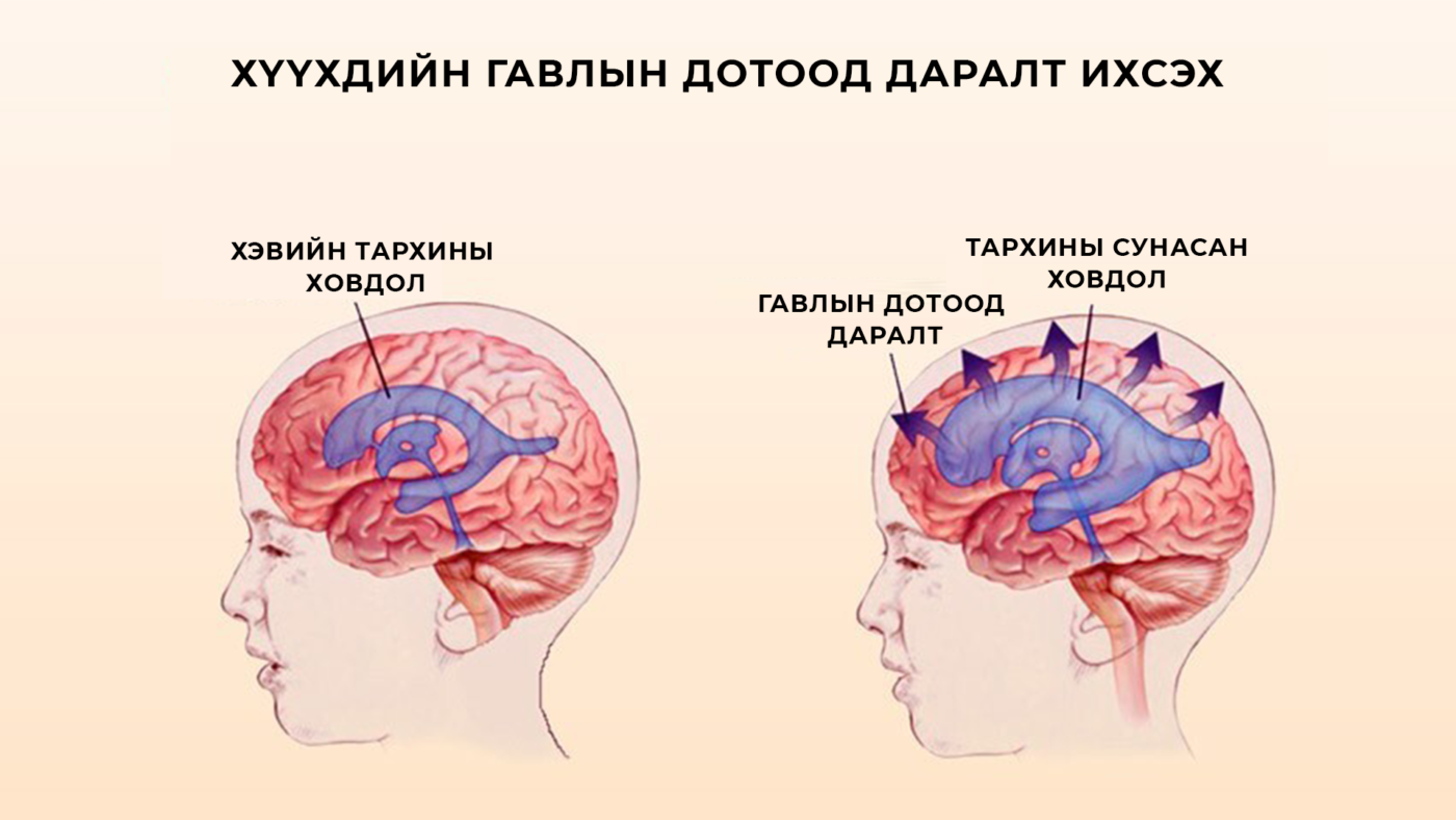 Внутричерепное давление симптомы. Внутричерепная гипертензия ликвор. Внутричерепное давление у ребенка 2 года симптомы. Доброкачественная внутричерепная гипертензия у детей. Синдром внутричерепной гипертензии у детей симптомы.