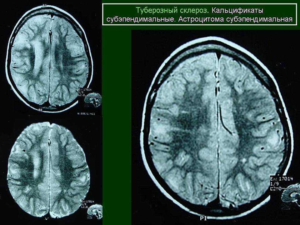 Туберозный склероз. Факоматозы (туберозный склероз). Ангиофибромы туберозный склероз. Туберозный склероз (болезнь Бурневилля). Туберозный склероз головного мозга мрт.