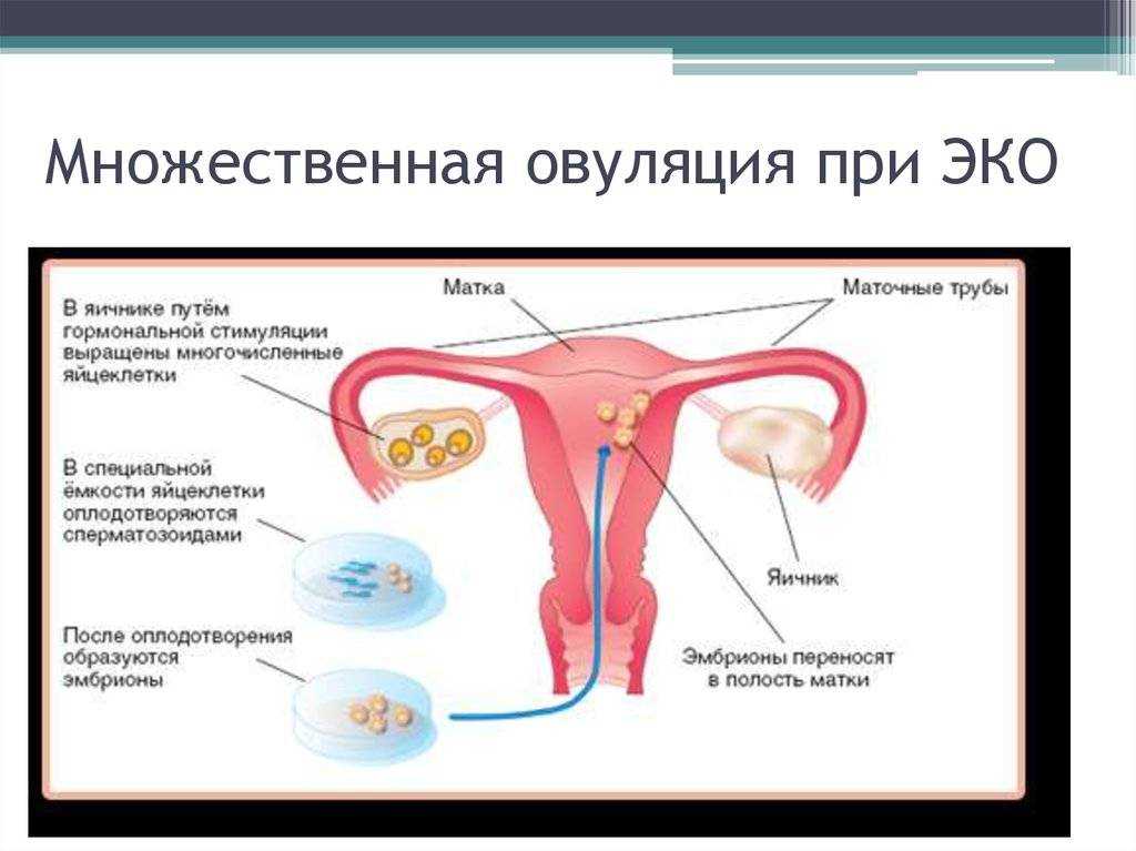 Забеременела без труб естественным путем. Перенос эмбрионов в полость матки. Беременность без труб естественным путем. Беременность без маточных труб.