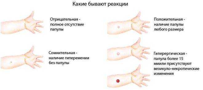 Проба манту детям