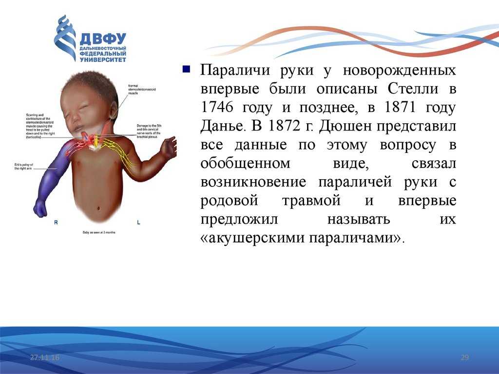 Паралич дюшена-эрба: причины, симптомы, принципы лечения