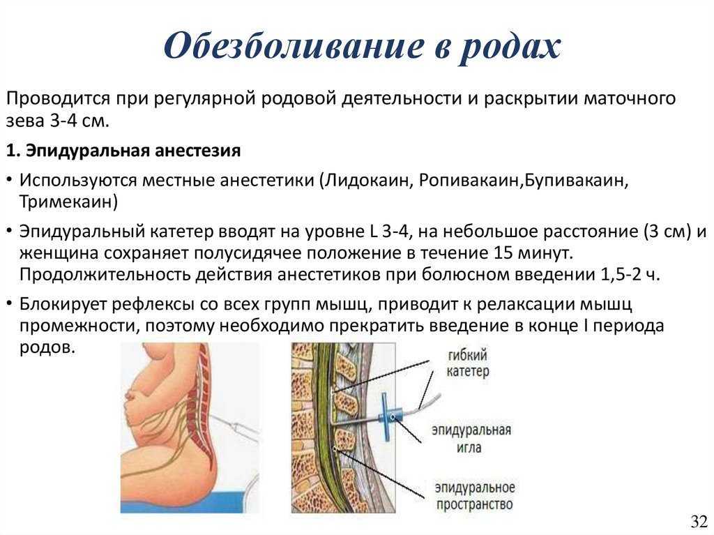 Эпидуральная анестезия картинки