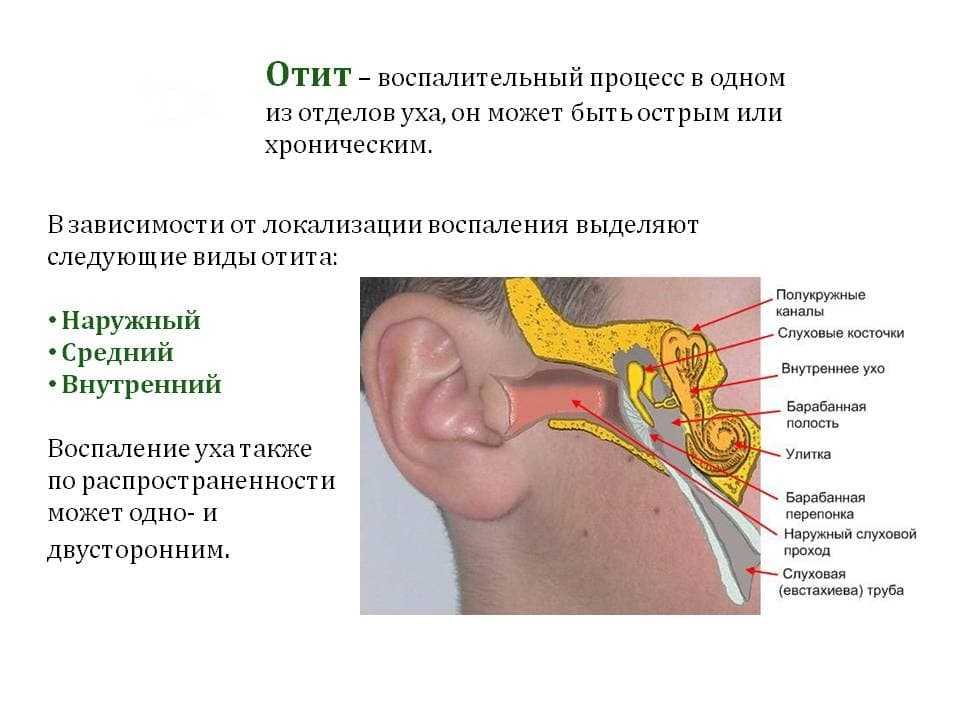 Экссудативный средний отит. лечение отита среднего уха у ребенка