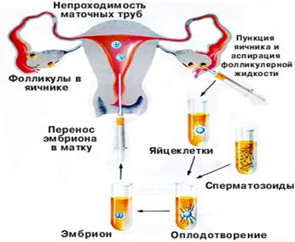 Непроходимость маточных труб – причины и следствия. есть ли шанс стать матерью