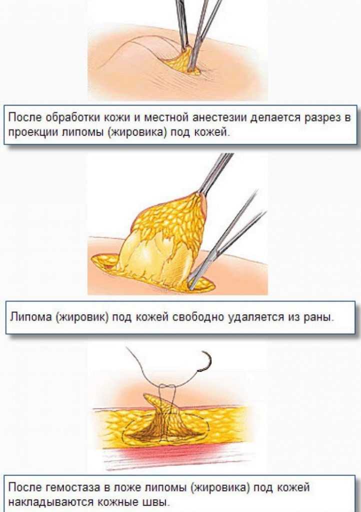 Просянка (белые угри, милиумы) – причины появления, лечение, профилактика