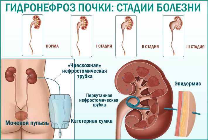 Гидронефроз - причины, симптомы, диагностика, лечение и профилактика