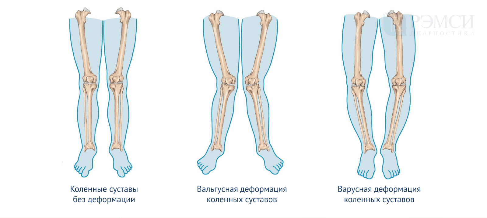 Почему ногу назвали ногой. Варусная деформация оси нижних конечностей. Варусная деформация коленных суставов рентген. Сгибательная и вальгусная деформация коленных суставов. Варусная и вальгусная деформация коленного сустава.