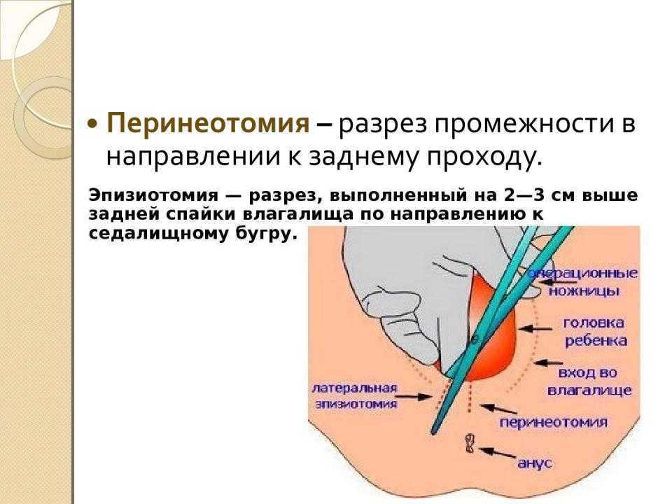 Эпизиотомия при родах: что это такое, когда ее делают, какие могут быть последствия?