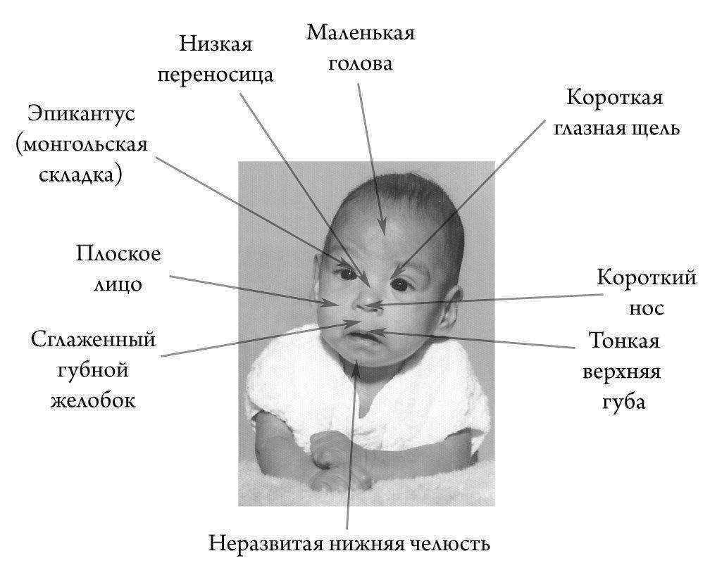 синдром ребенка рожденного алкоголиками