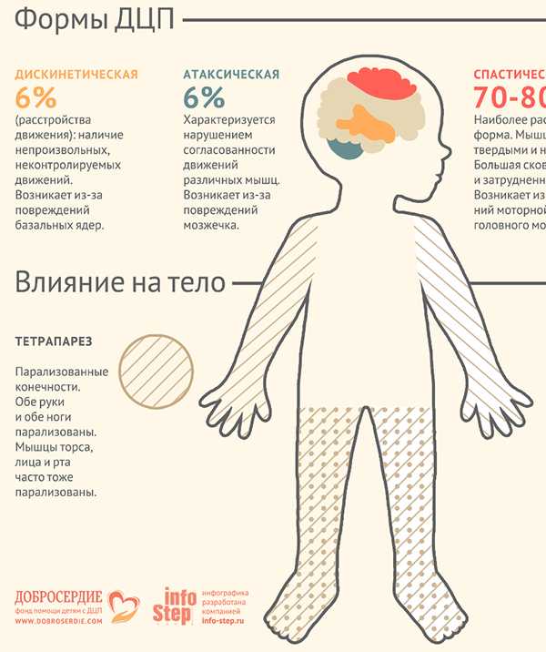 Синдром пирамидной недостаточности, как фактор риска дизартрии