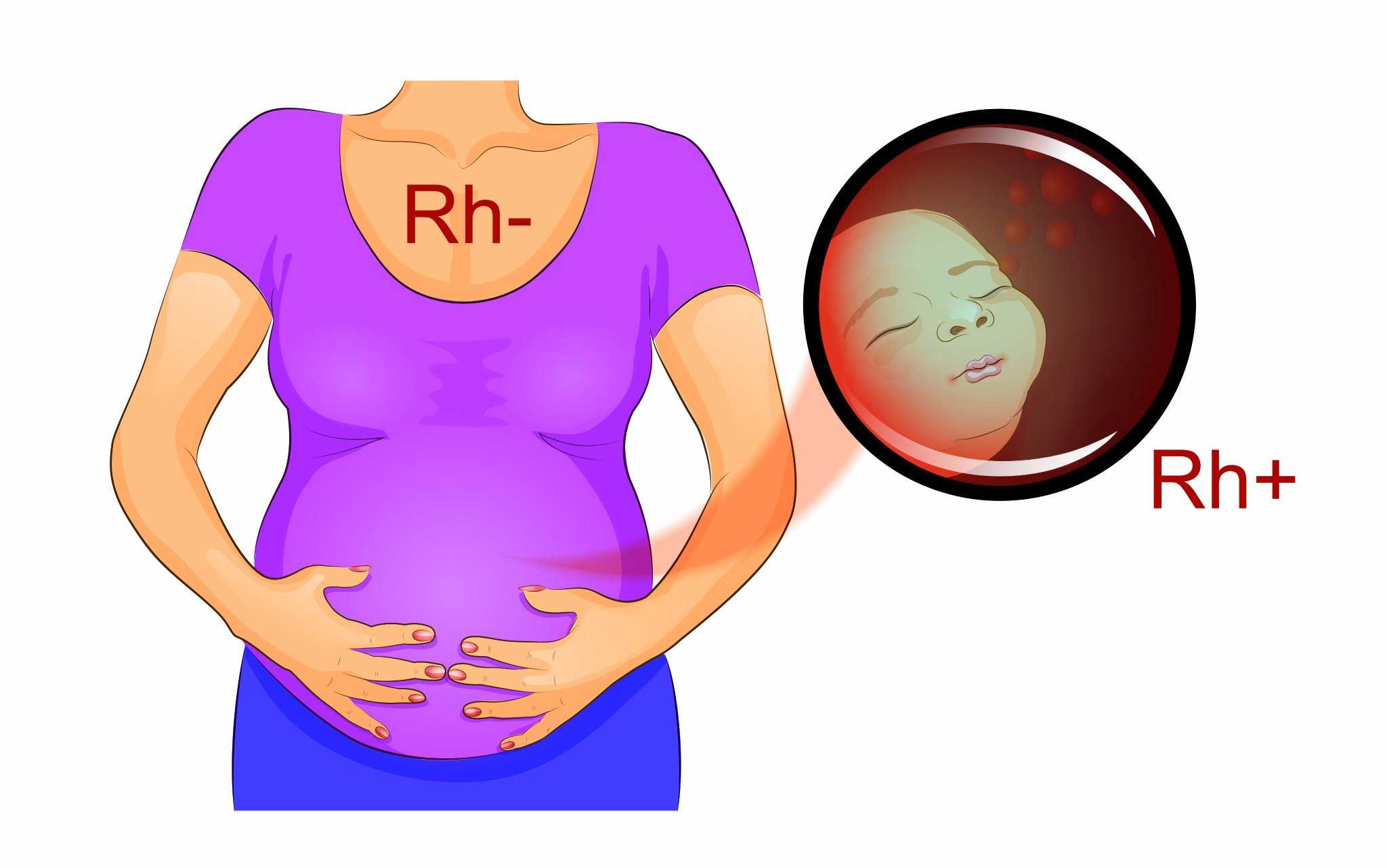 Резус фактор у беременных